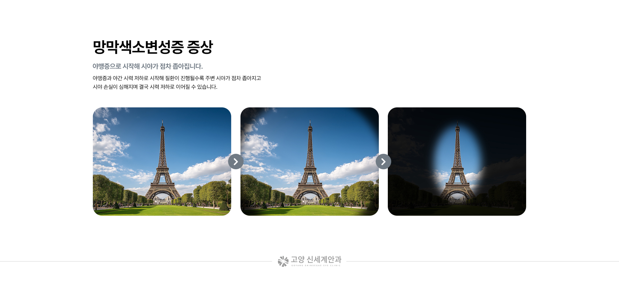 [망막색소변성증 증상 : 야맹증으로 시작해 시야가 점차 좁아집니다.] 야맹증과 야간 시력 저하로 시작해 질환이 진행될수록 주변 시야가 점차 좁아지고 시야 손실이 심해지며 결국 시력 저하로 이어질 수 있습니다. 