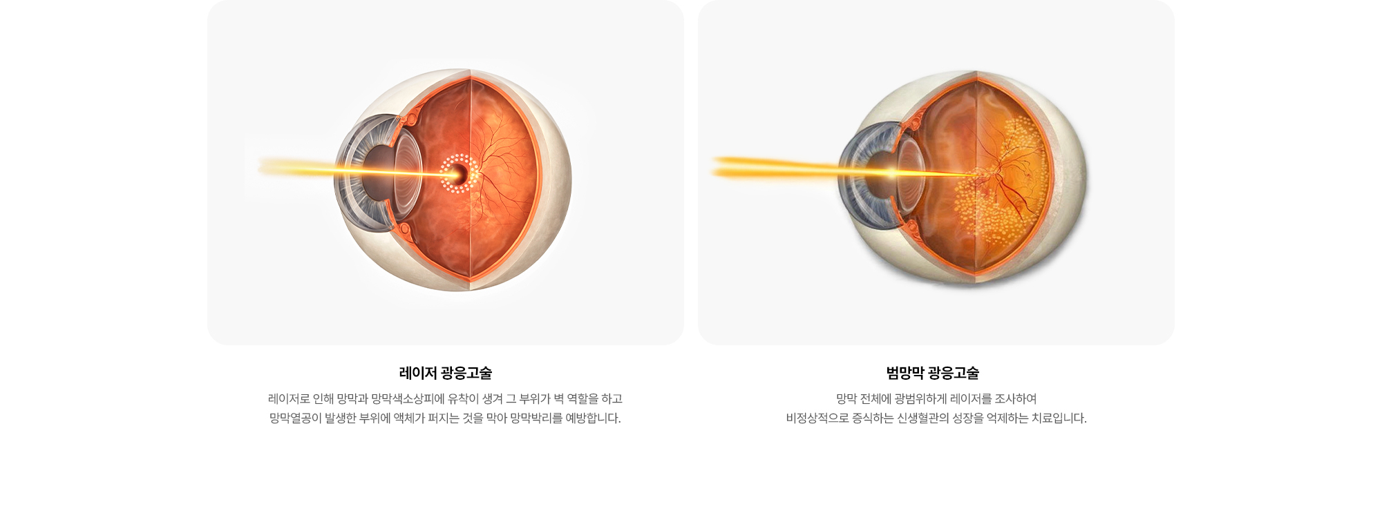 {레이저 광응고술} 레이저로 인해 망막과 망막색소상피에 유착이 생겨 그 부위가 벽 역할을 하고 망막열공이 발생한 부위에 액체가 퍼지는 것을 막아 망막박리를 예방합니다. {범망막 광응고술} 망막 전체에 광범위하게 레이저를 조사하여 비정상적으로 증식하는 신생혈관의 성장을 억제하는 치료입니다.