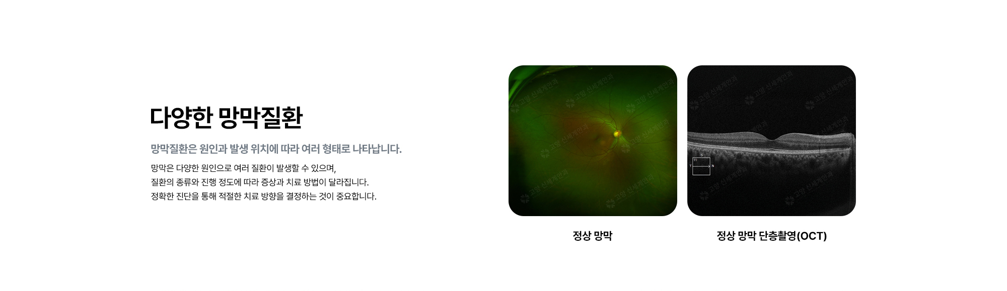 [다양한 망막질환 : 망막질환은 원인과 발생 위치에 따라 여러 형태로 나타납니다.] 망막은 다양한 원인으로 여러 질환이 발생할 수 있으며, 질환의 종류와 진행 정도에 따라 증상과 치료 방법이 달라집니다.