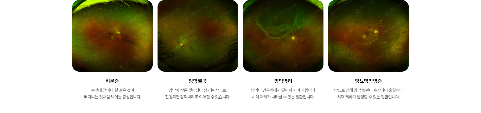{망막질환 종류} (1) 비문증 (2) 망막열공 (3) 망막박리 (4) 당뇨망막병증