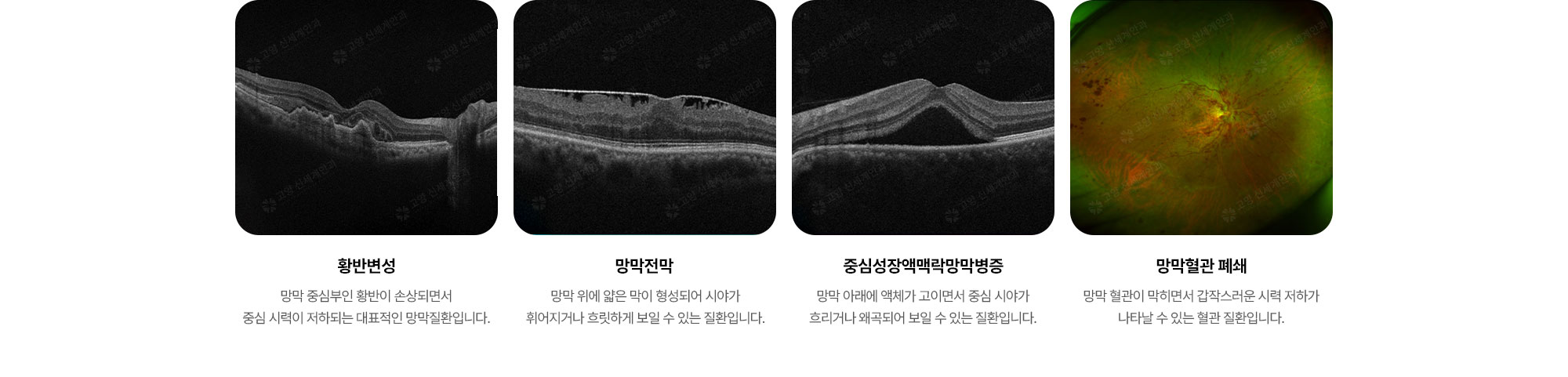 {망막질환 종류} (5) 황반변성 (6) 망막전막 (7) 중심성장액맥락망막병증 (8) 망막혈관 폐쇄
