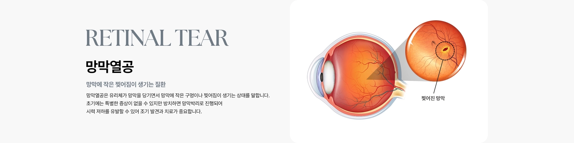 [망막열공 : 망막에 작은 찢어짐이 생기는 질환] 망막열공은 유리체가 망막을 당기면서 망막에 작은 구멍이나 찢어짐이 생기는 상태를 말합니다.