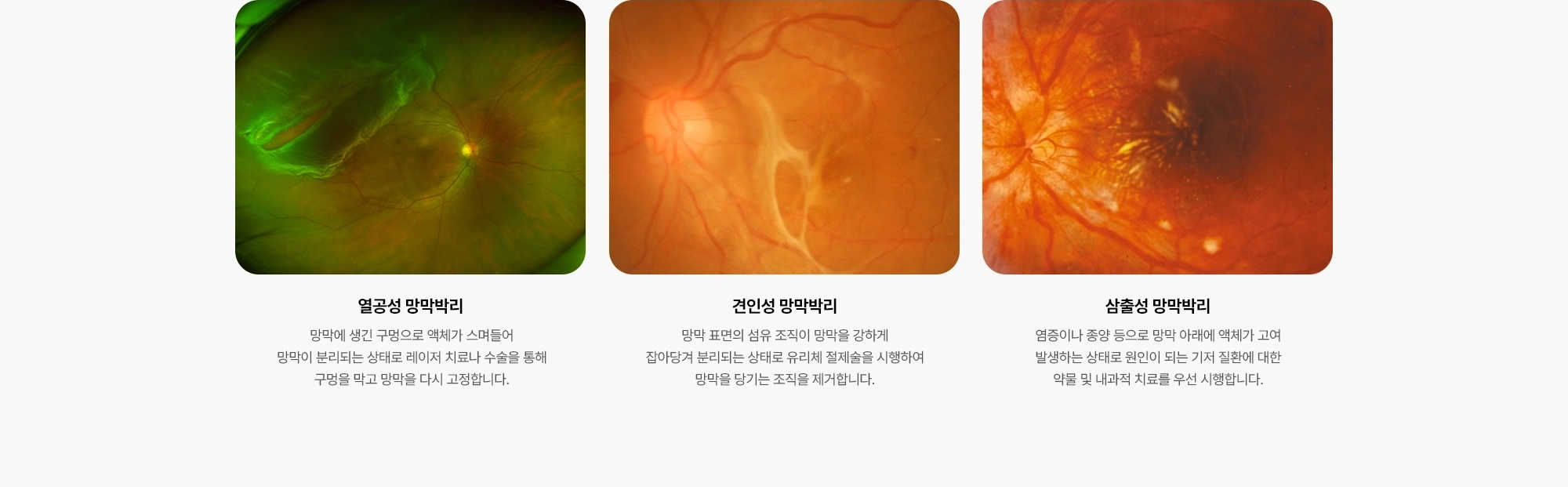 {열공성 망막박리} 망막에 생긴 구멍으로 액체가 스며들어 망막이 분리되는 상태로 레이저 치료나 수술을 통해 구멍을 막고 망막을 다시 고정합니다. {견인성 망막박리} 망막 표면의 섬유 조직이 망막을 강하게 잡아당겨 분리되는 상태로 유리체 절제술을 시행하여 망막을 당기는 조직을 제거합니다. {삼출성 망막박리} 염증이나 종양 등으로 망막 아래에 액체가 고여 발생하는 상태로 원인이 되는 기저 질환에 대한 약물 및 내과적 치료를 우선 시행합니다.