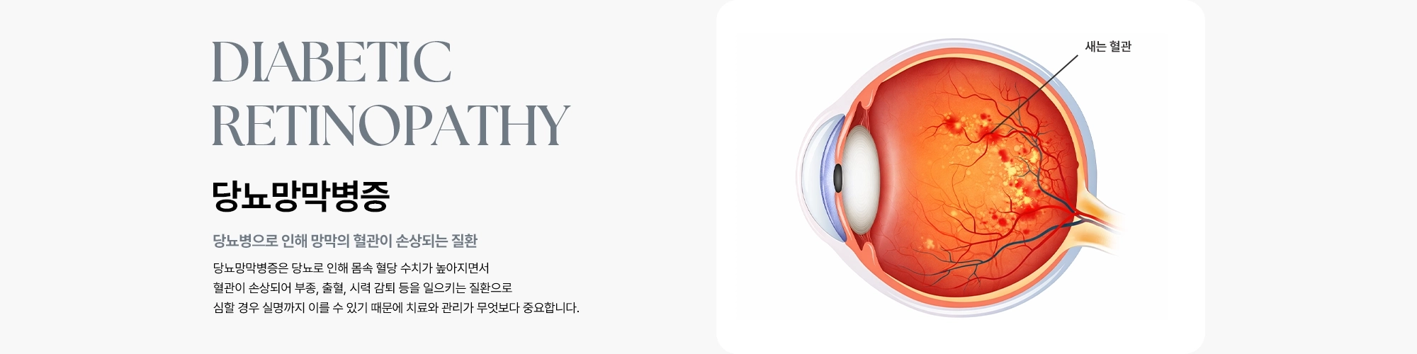 [당뇨망막병증 : 당뇨병으로 인해 망막의 혈관이 손상되는 질환] 당뇨망막병증은 당뇨로 인해 몸속 혈당 수치가 높아지면서 혈관이 손상되어 부종, 출혈, 시력 감퇴 등을 일으키는 질환으로 심할 경우 실명까지 이를 수 있기 때문에 치료와 관리가 무엇보다 중요합니다.