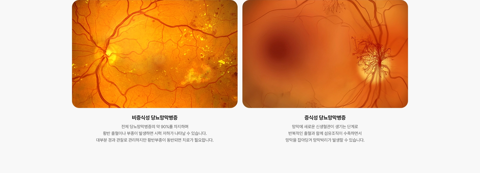  {비증식성 당뇨망막병증} 전체 당뇨망막병증의 약 90%를 차지하며 황반 출혈이나 부종이 발생하면 시력 저하가 나타날 수 있습니다. 대부분 경과 관찰로 관리하지만 황반부종이 동반되면 치료가 필요합니다. {증식성 당뇨망막병증} 망막에 새로운 신생혈관이 생기는 단계로 반복적인 출혈과 함께 섬유조직이 수축하면서 망막을 잡아당겨 망막박리가 발생할 수 있습니다.