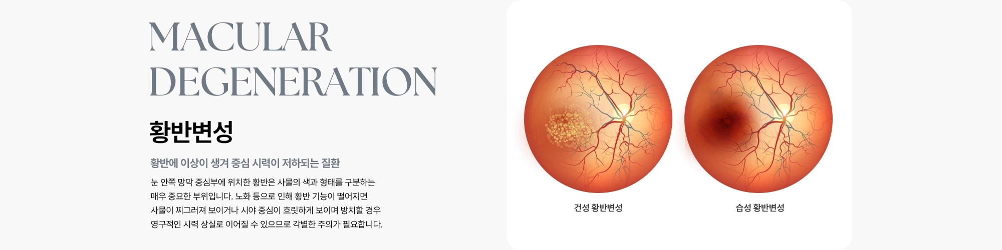 [황반변성 : 황반에 이상이 생겨 중심 시력이 저하되는 질환] 노화 등으로 인해 황반 기능이 떨어지면 사물이 찌그러져 보이거나 시야 중심이 흐릿하게 보이며 방치할 경우 영구적인 시력 상실로 이어질 수 있으므로 각별한 주의가 필요합니다.