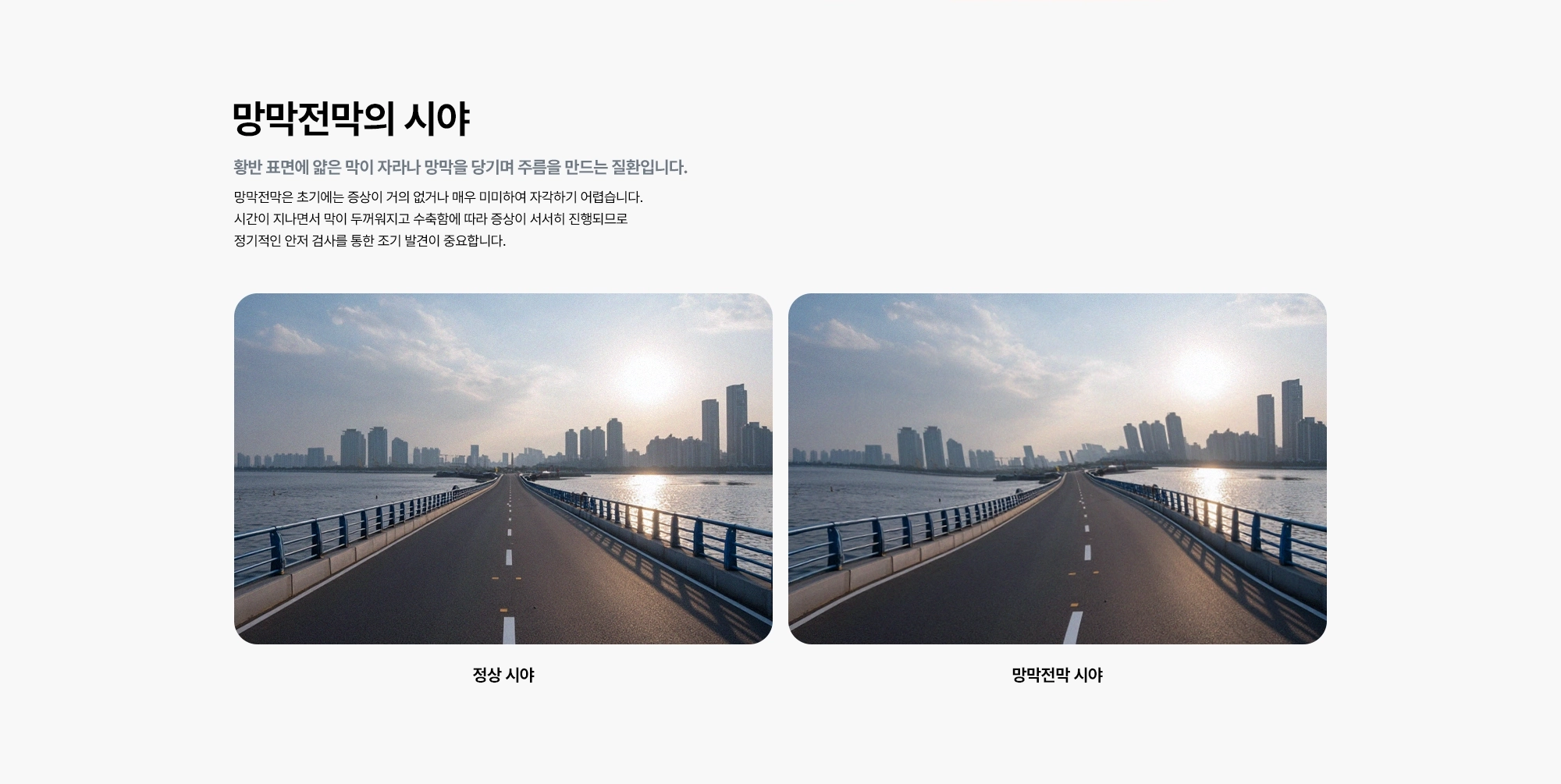 [망막전막의 시야 : 황반 표면에 얇은 막이 자라나 망막을 당기며 주름을 만드는 질환입니다.] 망막전막은 초기에는 증상이 거의 없거나 매우 미미하여 자각하기 어렵습니다. 시간이 지나면서 막이 두꺼워지고 수축함에 따라 증상이 서서히 진행되므로 정기적인 안저 검사를 통한 조기 발견이 중요합니다.