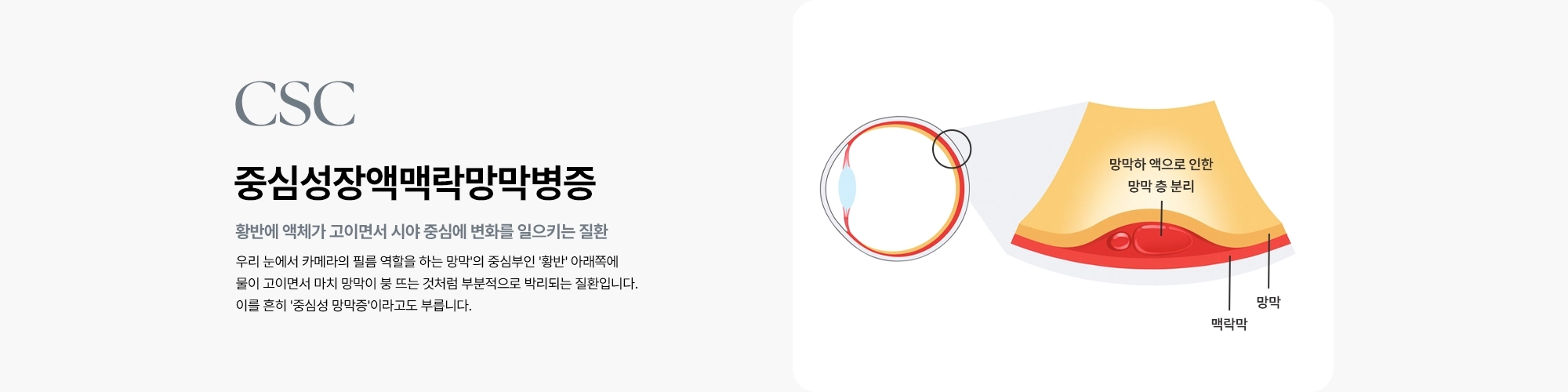 [중심성장액맥락망막병증 : 황반에 액체가 고이면서 시야 중심에 변화를 일으키는 질환] 우리 눈에서 카메라의 필름 역할을 하는 망막'의 중심부인 '황반' 아래쪽에 물이 고이면서 마치 망막이 붕 뜨는 것처럼 부분적으로 박리되는 질환입니다. 이를 흔히 '중심성 망막증'이라고도 부릅니다.