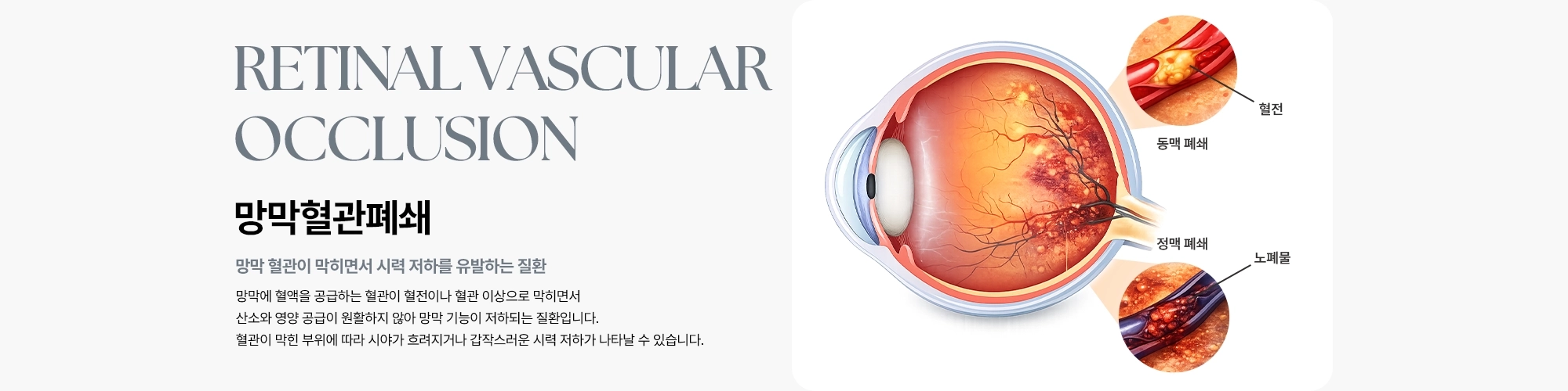 [망막혈관폐쇄 : 망막 혈관이 막히면서 시력 저하를 유발하는 질환] 망막에 혈액을 공급하는 혈관이 혈전이나 혈관 이상으로 막히면서 산소와 영양 공급이 원활하지 않아 망막 기능이 저하되는 질환입니다.