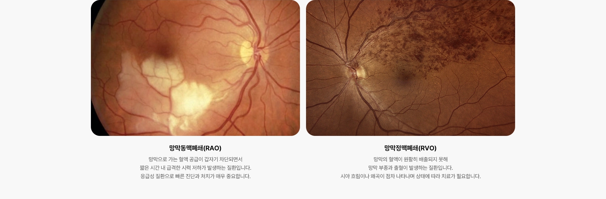 {망막동맥폐쇄(RAO)} 망막으로 가는 혈액 공급이 갑자기 차단되면서 짧은 시간 내 급격한 시력 저하가 발생하는 질환입니다. 응급성 질환으로 빠른 진단과 처치가 매우 중요합니다. {망막정맥폐쇄(RVO)} 망막의 혈액이 원활히 배출되지 못해 망막 부종과 출혈이 발생하는 질환입니다. 시야 흐림이나 왜곡이 점차 나타나며 상태에 따라 치료가 필요합니다.