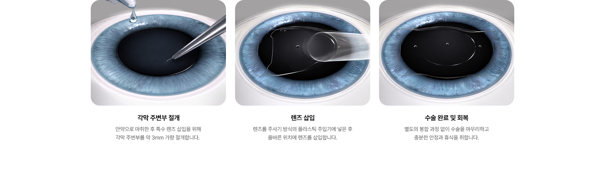 {각막 주변부 절개} 안약으로 마취한 후 특수 렌즈 삽입을 위해 각막 주변부를 약 3mm 가량 절개합니다. {렌즈 삽입} 렌즈를 주사기 방식의 플라스틱 주입기에 넣은 후 올바른 위치에 렌즈를 삽입합니다. {수술 완료 및 회복} 별도의 봉합 과정 없이 수술을 마무리하고 충분한 안정과 휴식을 취합니다.