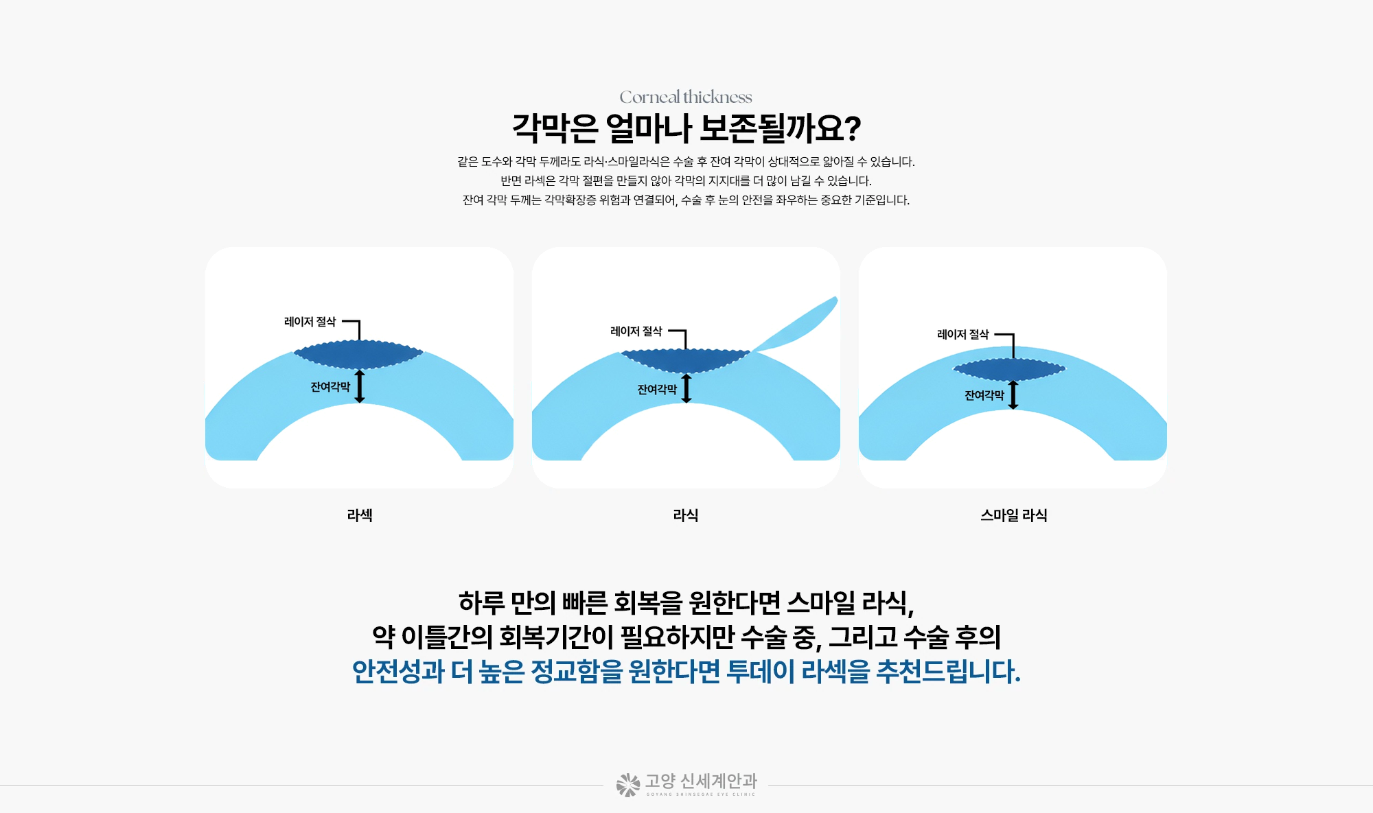 Corneal thickness 각막은 얼마나 보존될까요? 같은 도수와 각막 두께라도 라식·스마일라식은 수술 후 잔여 각막이 상대적으로 얇아질 수 있습니다. 반면 라섹은 각막 절편을 만들지 않아 각막의 지지대를 더 많이 남길 수 있습니다. 잔여 각막 두께는 각막확장증 위험과 연결되어, 수술 후 눈의 안전을 좌우하는 중요한 기준입니다. 레이저 절삭 레이저 절삭 레이저 절삭 잔여각막 잔여각막 잔여각막 라섹 라식 스마일 라식 하루 만의 빠른 회복을 원한다면 스마일 라식, 약 이틀간의 회복기간이 필요하지만 수술 중, 그리고 수술 후의 안전성과 더 높은 정교함을 원한다면 투데이 라섹을 추천드립니다.
