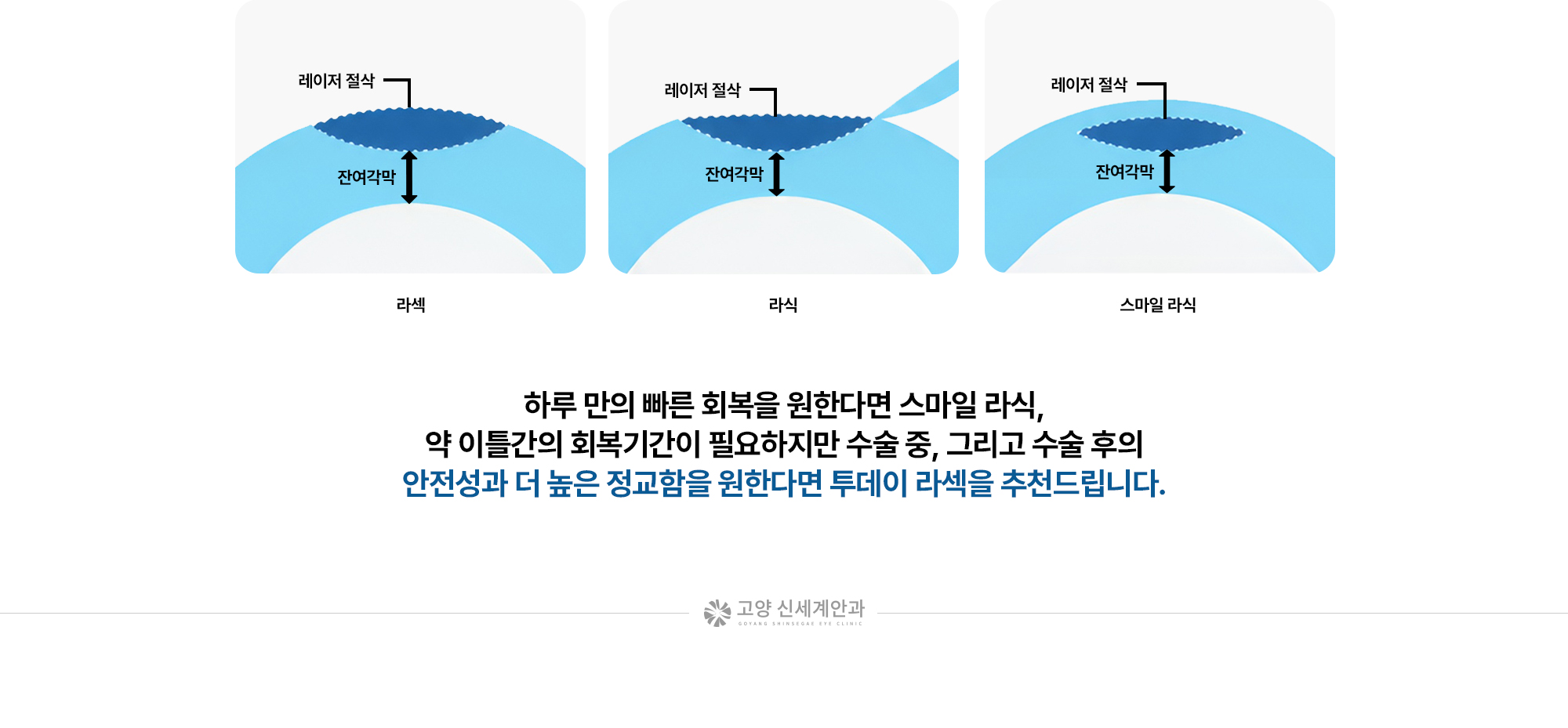 하루 만의 빠른 회복을 원한다면 스마일 라식, 약 이틀간의 회복기간이 필요하지만 수술 중, 그리고 수술 후의 안전성과 더 높은 정교함을 원한다면 투데이 라섹을 추천드립니다.